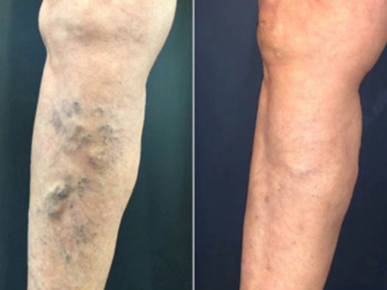 Tratamento de varizes grossas e safena a laser